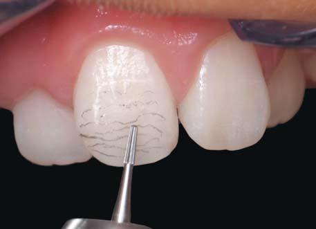 At that point, the lingual aspect can be adjusted using a football-shaped carbide bur. The facial contour can be developed using rotary instrumentation to ensure that the tooth has three planes.