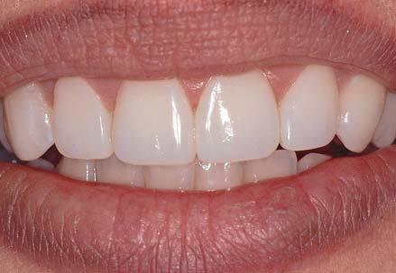 Postoperative appearance of the restoration. With the correct finishing and polishing techniques, a mirror image of the adjacent natural tooth was created.