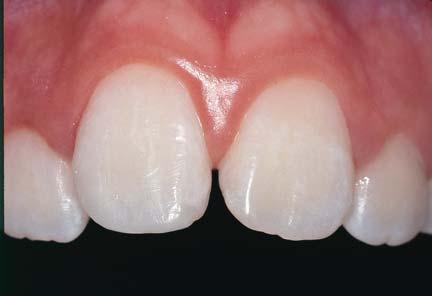 Direct resin veneers require additional time, and there is no need to rush through this important step.
