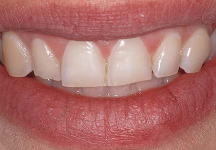 Textured Surface To create a youthful appearance that is characterized by surface irregularities (ie, the overall shape of the tooth is correct, but small surface changes are evident in the light
