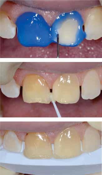 Balk J Dent Med, Vol 20, 2016 Aesthetic Closure Using Direct Composite Resin Build-Ups 119 The bleaching procedure followed an internal and external bleaching protocol, however it led to only minor