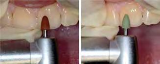 A single layer of a slightly darker shade of enamel (Tetric Evo Ceram A3) was applied onto the cervical-labial and cervicalproximal surfaces, whereas a lighter shade of enamel (Tetric Evo Ceram A2)