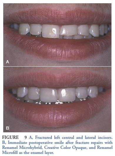 tooth reshaping, and tooth realignment to obtain a desired smile design (Figure 11).