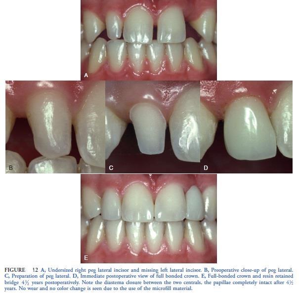 These types of restorations require minimal or