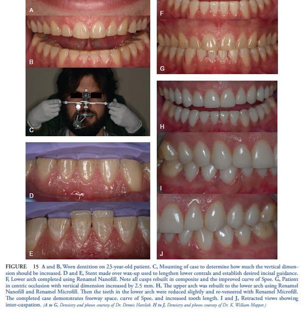 Clinical conservation concepts: The object of minimally invasive dentistry with the use of direct resin bonding is the preservation of tooth structure.
