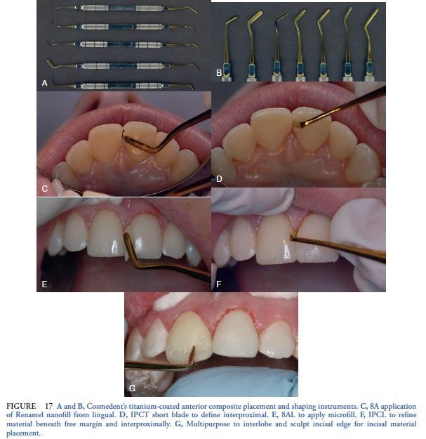 proper instrumentation, such as Cosmedent s anterior instruments. These titanium-coated instruments make it easier to apply and refine morphological aspects of tooth formation (Figure 17).