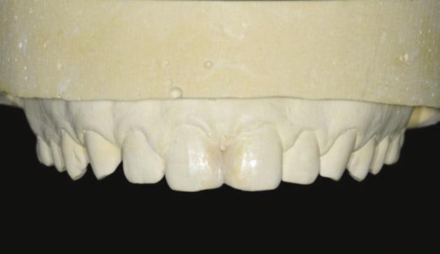 A study model was fabricated to measure the actual length between the top of the papilla and incisal edge of the central incisors.
