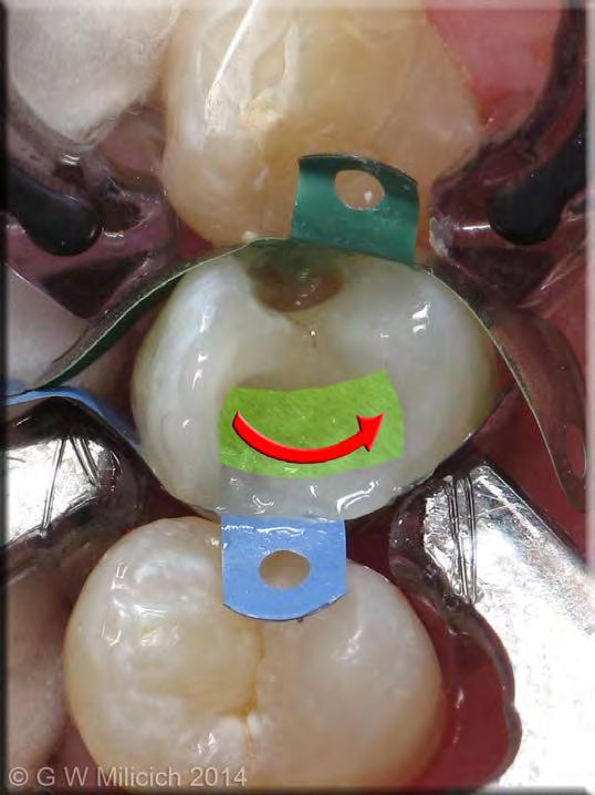 Place 3mm wide length of THM Ultra buco-lingually Down the buccal wall,