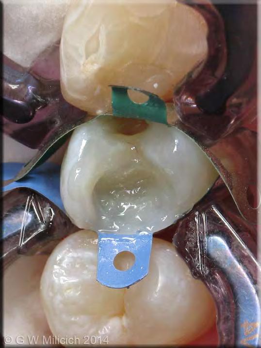 Completion of the Ribbond torsion box core EverX Posterior (GC) glass
