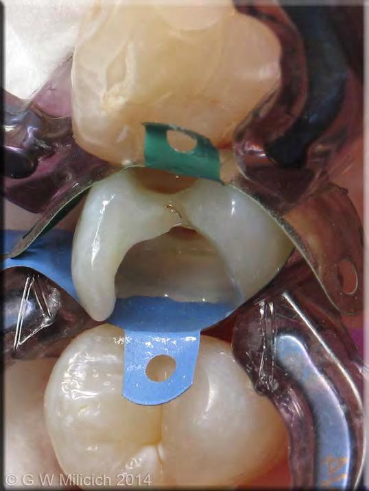 Thin layer of radio-opaque flow placed only on the gingival