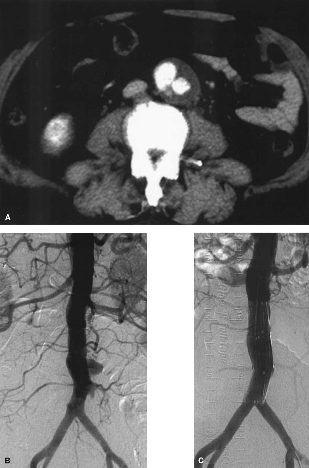 JOURNAL OF VASCULAR SURGERY Volume 38, Number 2 Tsuji et al 385 Fig 2. Patient 1. Penetrating atherosclerotic ulcer in the abdominal aorta, with intramural hematoma.