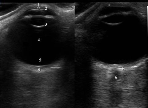 B-scan imaging of the normal eye 1. Eye lid, 2.Cornea, 3.Posterior lens capsule, 4.Vitreous gel, 5.Retina, choroid, sclera, 6. Optic nerve c.
