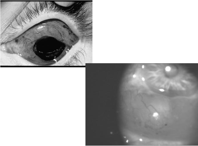 Case Study Treatment Strategy 81 Year Old Female Severe Dry Eye, Exposure Keratopathy (OD>OS) No response to Drops (Restasis ) or Punctal Plugs Treatment