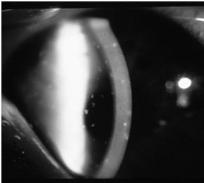 Keratitis (Corneal infiltrate) Treatment / Management What would you do?