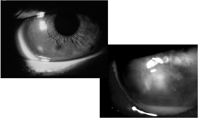 Steroids for Corneal Ulcers Trial (SCUT) NEI Study The pilot study showed better visual acuity and smaller infiltrate/scar size but longer re-epithelialization time with steroids treatment.