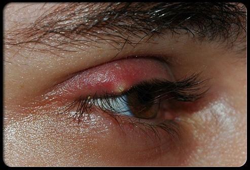 FOLLICULITIS Stye Basis of the eyelashes