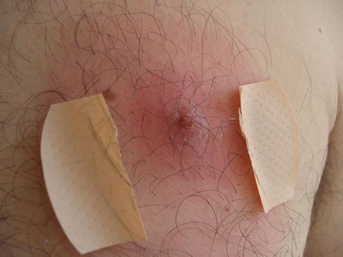 Deeper infections of the hair follicles