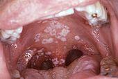 Lips : cheleitis Oral