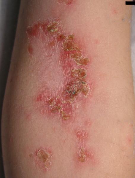 IMPETIGO Superficial skin infection Epidermis