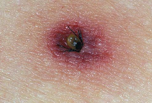 Early Localized Stage - Erythema Migrans (EM) Rash Ticks must be attached for at least 24-48 hours to transmit the bacteria. The EM rash expands in size over time and often has partial clearing.