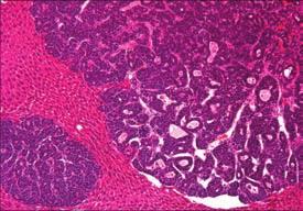 (J) Hepatocellular malignant neoplasm; not otherwise
