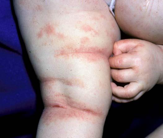 An Update on Topical Therapy for Atopic Dermatitis Amy S.