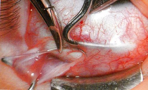 Suture in the sclera Lateral & behind the insertion