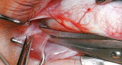 Dissection from the sclera The posterior part is cut through the muscle: