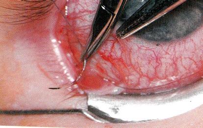 Suture the muscle Suture is put through the anterior tip
