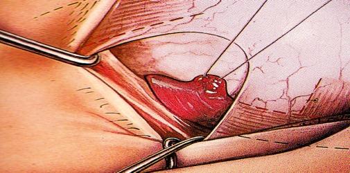 Anteroposition of the inferior oblique muscle The muscle is reattached at the equator of the