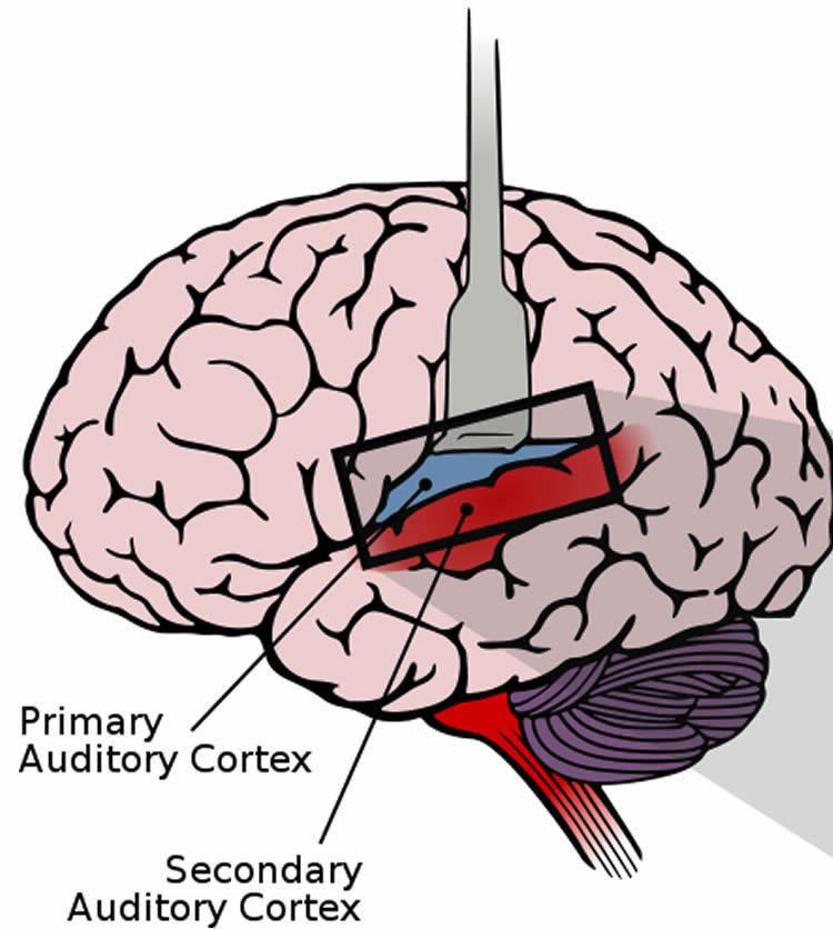Primary auditory cortex: Brodmann areas 41 and 42. Secondary auditory cortex: Brodmann areas 22 and 37.