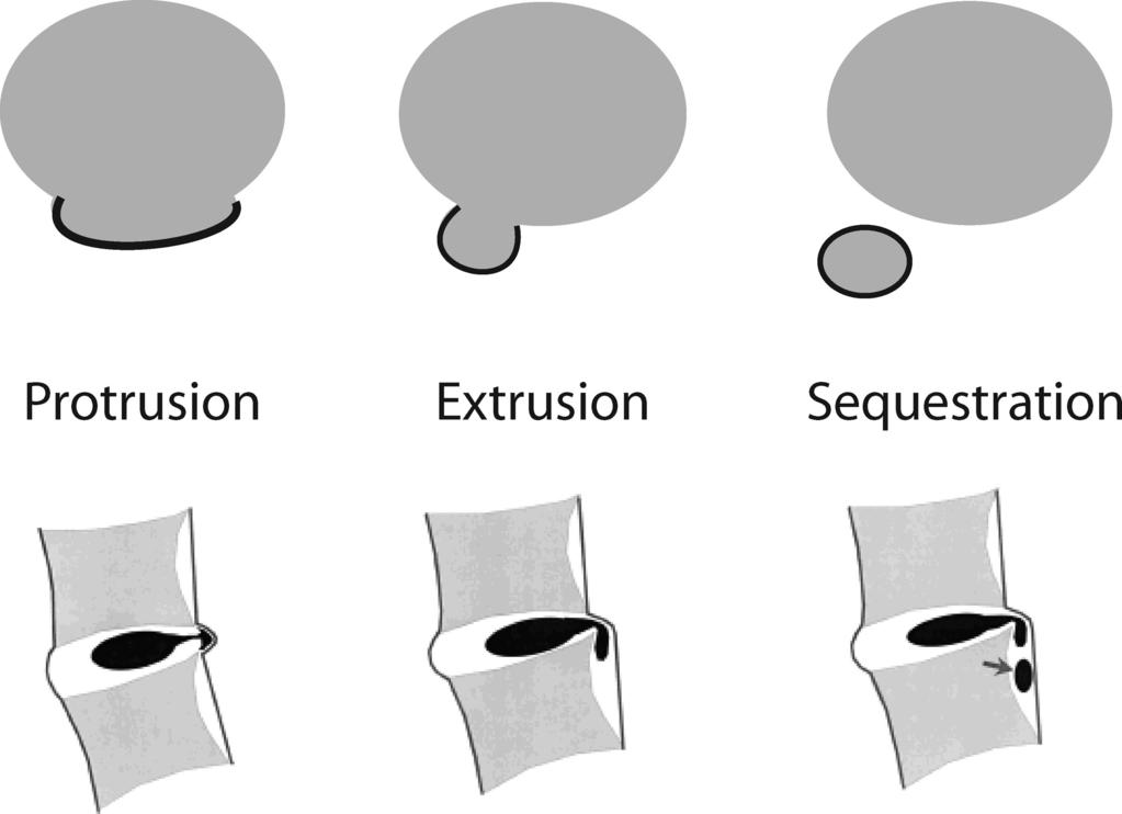 430 Spine Volume 33 Number 4 2008 Figure 2. Schematic demonstrating herniation morphologies. In this study, extrusions and sequestrations were combined as extrusions/sequestrations.