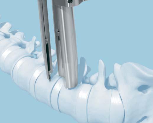 Insert Retractor continued 5 Insert retractor continued For further retraction, the cranial and caudal blades can independently provide up to 15 of cranial and caudal angulation.