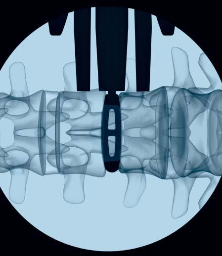 Each trial spacer has a center opening that can be visualized in an AP fluoroscopic view.