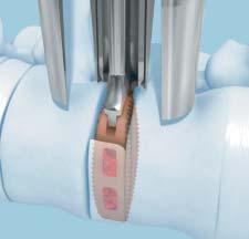 Note: The anterior/ posterior marker pins of the implant are located approximately 2.25 mm from the edges of the implant.