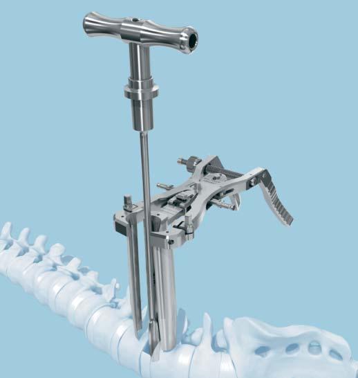 Oracle Spacer System The Oracle Spacer System is a comprehensive set of instruments and implants designed to support a direct lateral approach to the lumbar spine.
