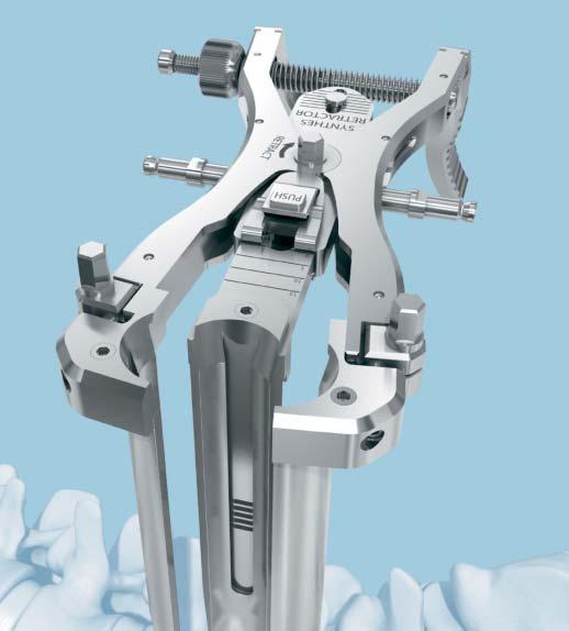 The Oracle spacer can be inserted through either an open or minimally invasive lateral approach.