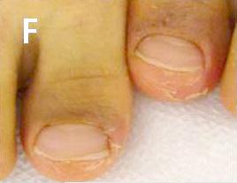 7 weeks for proximal nail fold, lateral nail fold and hyponychium lesions, respectively (Fig. 3C).