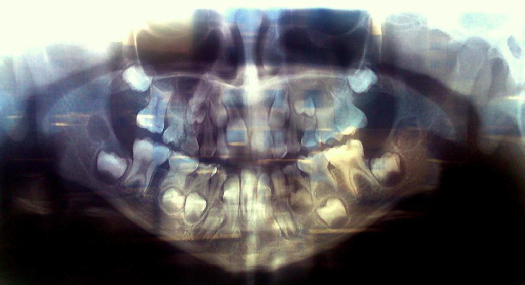 Figure 3: Panoramic radiography of the patient before treatment included diet and parent counseling and oral prophylaxis using polishing brush.