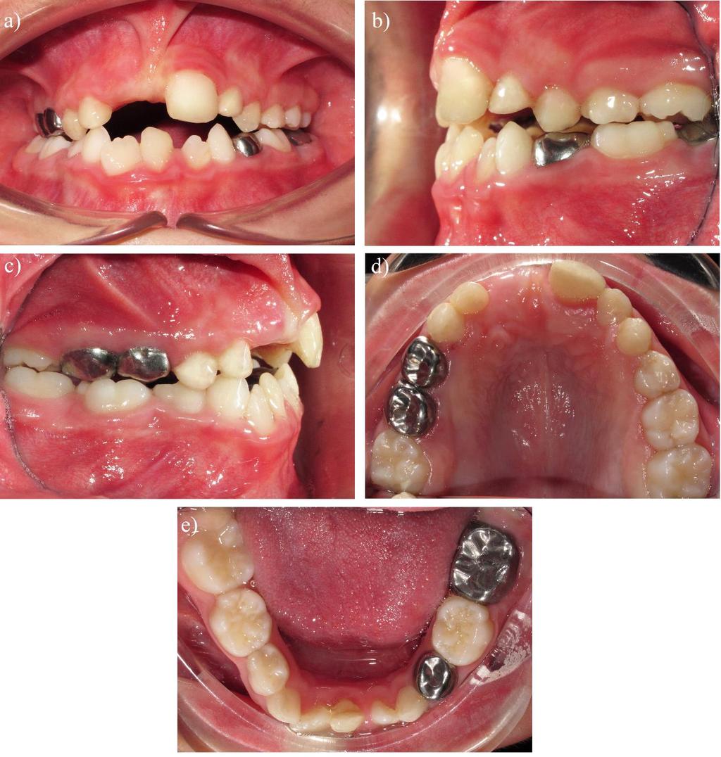 Figure 4: Intra-oral views after treatment. a) Frontal view, b) left lateral view, c) right lateral view, d) upper occlusal view, e) lower occlusal view nerves with distinct dental anomalies.