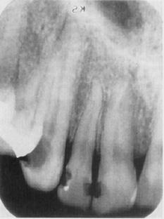 Radiographic Signs of Periodontal