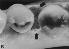 improperly adapted fixed and removable prostheses overcontoured restorations and crowns plaque retention around