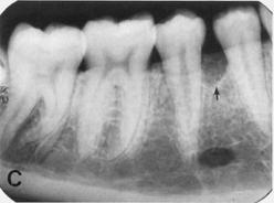 that exceed the adaptive capacity of the supporting periodontal tissues crown root ratio root morphology