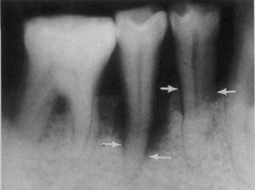 tooth (root and crown) not covered by bone to the amount of root in bone Example: if 12 mm of the tooth is not