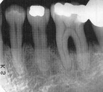 Periodontitis - mild bone loss (up to 30%) Haring & Lind