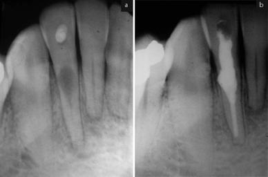 EXTERNAL RESORPTION caused by trauma, orthodontics, chronic