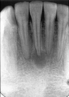pulp polyps asymptomatic, tooth may require endo or