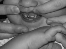 maxillary central incisors usually