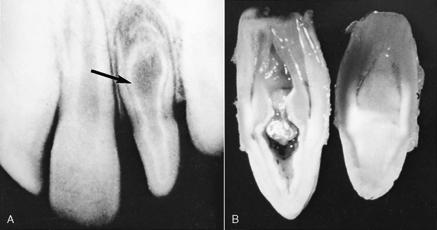 incisor most common peg lateral also commonly seen in third