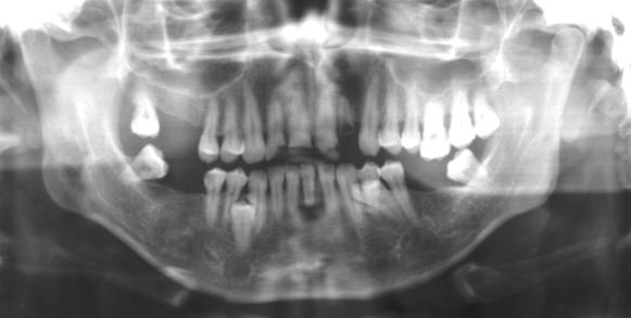 mandibular foramen, 16. mandibular canal and mental foramen, 17. mental ridge, 18. hyoid bone, 19. hard palate, 21.